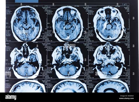 the villages brain mri